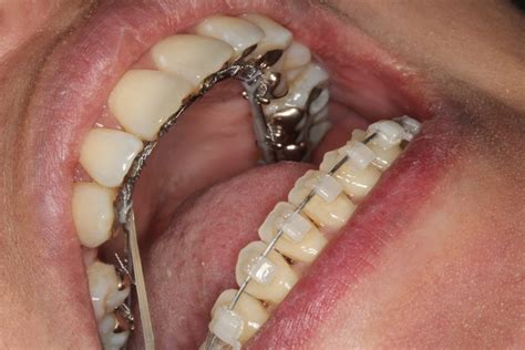 Lingual Braces Contour Orthodontists