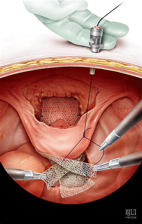 Laparoscopic Sacrocolpopexy Gaston 2011 BJU International Wiley