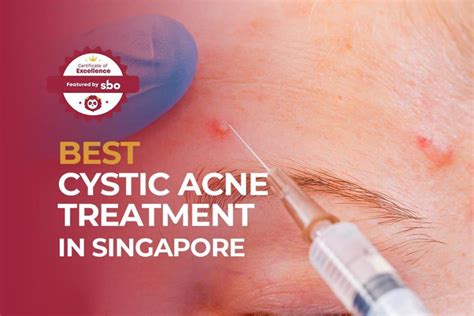10 Best Cystic Acne Treatment In Singapore To Help You Face Your Fears