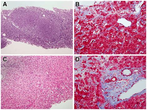 Typical Histologic Findings In Patients With Nodular Regenerative