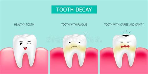 Step Of Tooth Decay Formation Healthy Tooth Forming Dental Plaque And