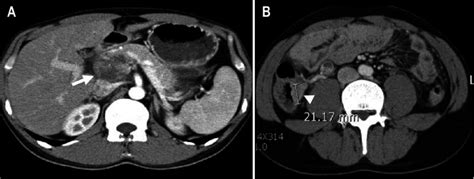 An Enlarged Lymph Node Was Found In The Periportal Area A Arrow A