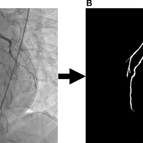 A Conventional Angiography Image Showing The Coronary Vasculature After