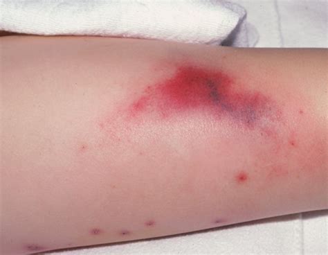 Ecchymosis Definition Bruising Pictures Causes Treatment