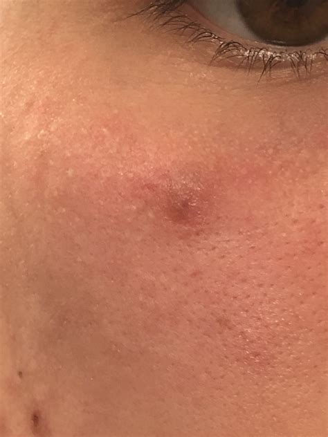 Mysterious Bump Under Eye Help — Its Been A Month General Acne