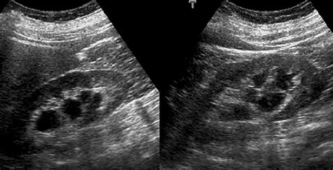 Bilateral Parapelvic Cysts Mimicking Hydronephrosis In A 55 Year Old