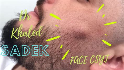 Face Cyst Removal By Dr Khaled Sadek Lipomacyst Com Youtube