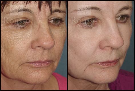Patient 2126625 Chemical Peel Before And After Rousso Adams Facial Plastic Surgery