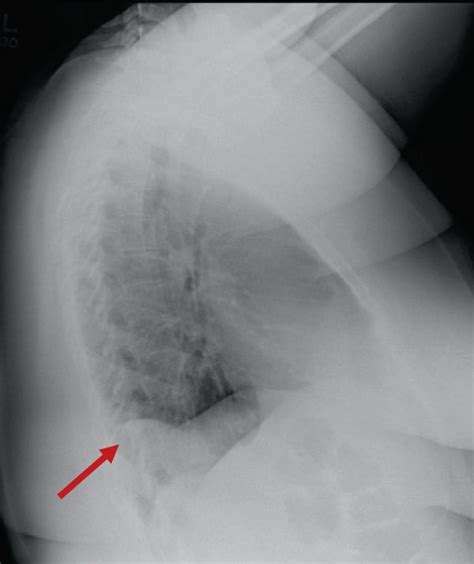 Lateral Chest Radiograph Showing A Mass Density In The Right Posterior