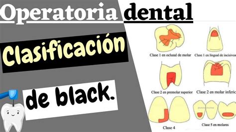 ClasificaciÓn De Las Cavidades Dentales Segun Black Caries Dental
