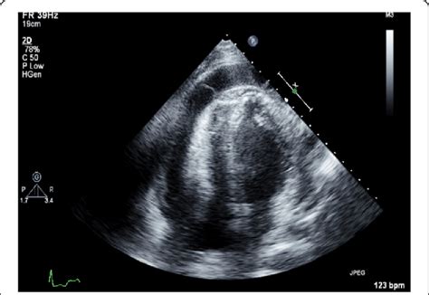 Transthoracic Echocardiogram Four Chamber View Showing Pericardial