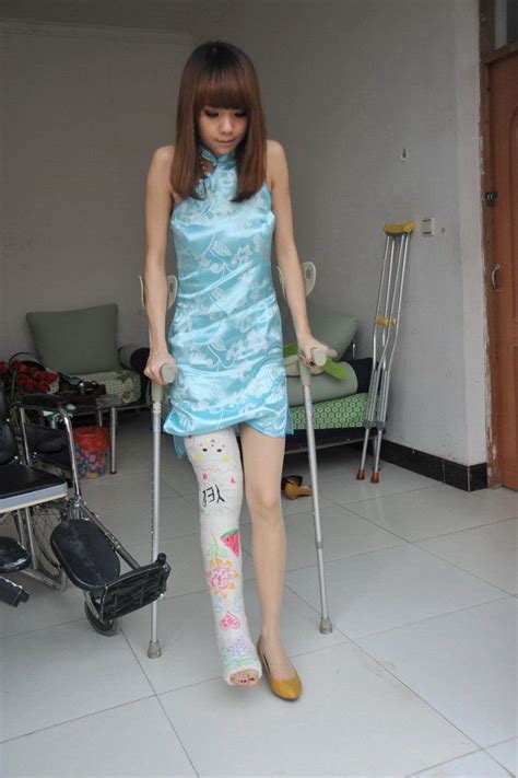 sehr süße Frau mit wunderschönem Gipsbein Leg cast Summer dresses Fashion