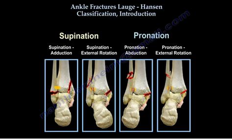 Lauge Hansen Classification Of Ankle Fractures Orthopaedicprinciples Com