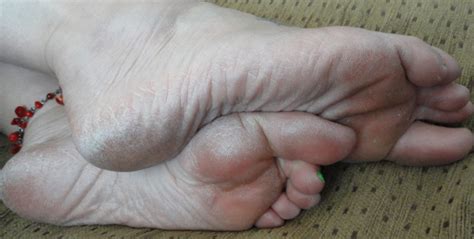 Dry Skin Foot Conditions