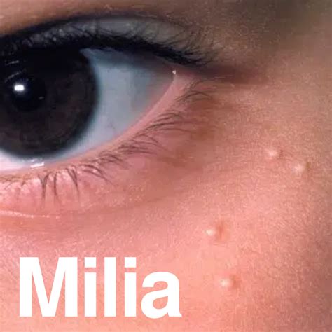 What Is Milia How To Stop It And How To Treat It