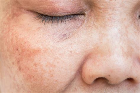 5 Ways To Treat Skin Discoloration