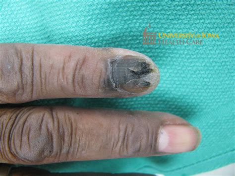 A Brown And Black Plaque On The Proximal Nail Fold Extending Onto The