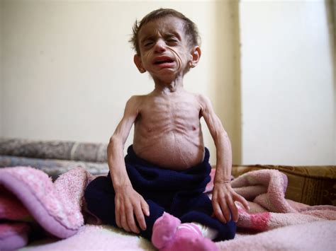 Shocking photo of starving Syrian girl shows the barbarity of war - Business Insider