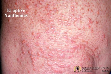 Xanthomas Signs Of Dyslipidemia Academic Dermatology Of Nevada