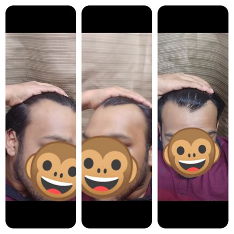 You may be suffering a slow receding hairline. Is this a maturing hairline or a receding hairline?. Im 20 ...