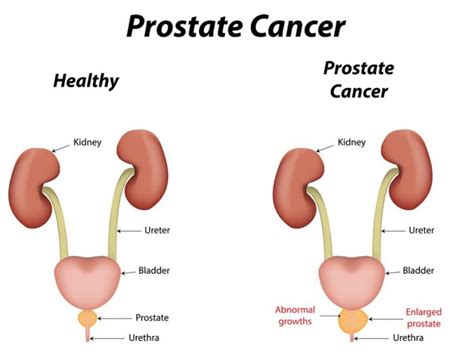 Shifting The Paradigm Of Testosterone Replacement Therapy In Prostate Cancer Excelmale