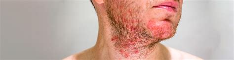 Alpharetta Ga Seborrheic Dermatitis Treatment Causes Symptoms Johns