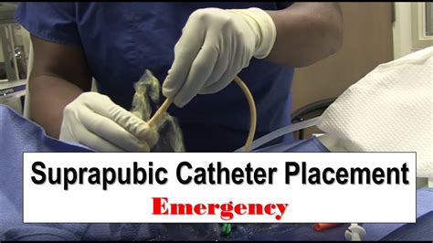 Suprapubic Catheter Policy And Procedure Suprapubic Catheter Replacement By Nurses Shotgnod