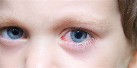 Pink Eye Causes Symptoms Risks And Treatment Anaheim Eye Institute