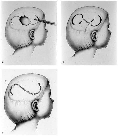 Cranioplasty Neupsy Key
