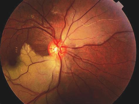 Branch Retinal Artery Occlusion Ophthalmology Education Blog
