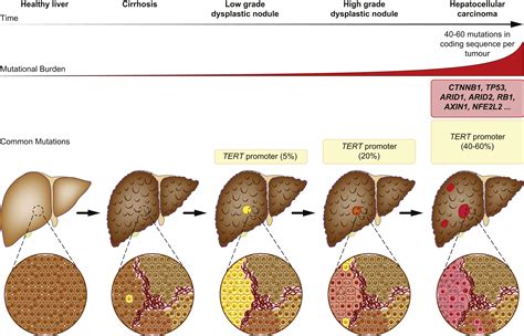 The Landscape Of Gene Mutations In Cirrhosis And Hepatocellular