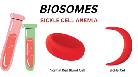 Sickle Cell Anemia Sickle Cell Disease Red Blood Disease Red Blood