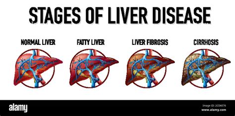 Stages Of Liver Disease Illustration Stock Vector Image And Art Alamy