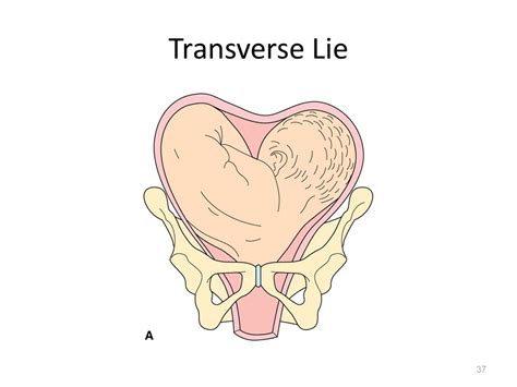 Breech Home4birth