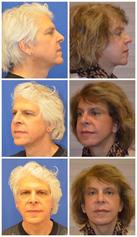 as trans women become more visible facial feminization surgery expands