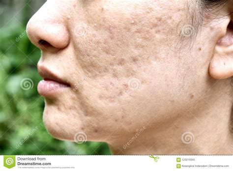 Skin Problem With Acne Diseases Close Up Woman Face With Whitehead