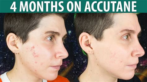 Accutane For Persistent Mild Acne — 4 Month Update Youtube