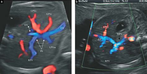 Fetal Portal Vein Ultrasound