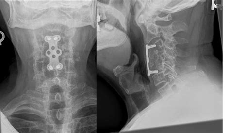 Pdf Pathological Burst Fracture In The Cervical Spine With Negative