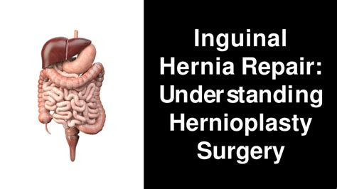 Ppt Inguinal Hernia Hernioplasty Surgery Powerpoint Presentation