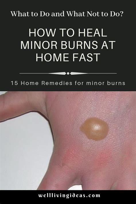 How To Heal Burn Blisters Fast Home And Garden Reference