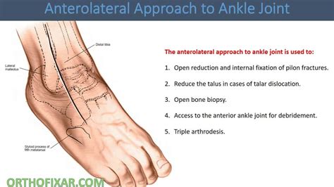 Dislocated Ankle Artofit