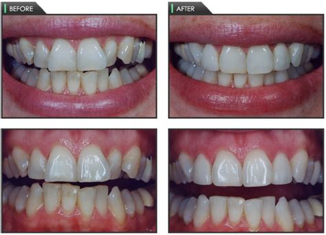 What Is Tooth Contouring Dr Chauvin