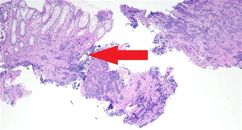 Cureus Metastatic Rectal Small Cell Carcinoma A Case Report