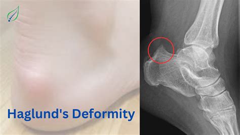 Haglunds Deformity Causes Symptoms And Treatment Options Best Back Pain Slip Disc Knee