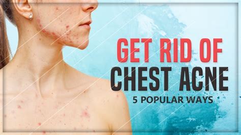 5 Home Remedies That Will Make Your Chest Acne Vanish Youtube