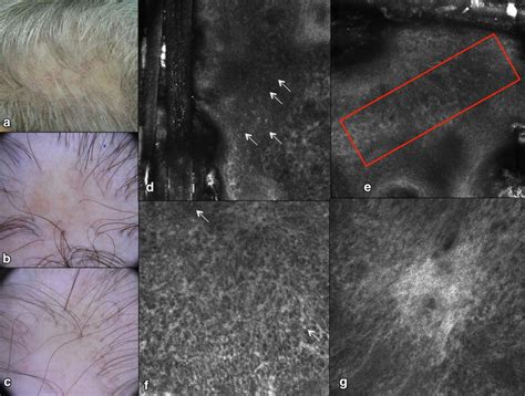 Lichen Planus Pilaris A Clinic Image Showing Alopecic Area Of The