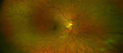 Roth Spots Bacterial Endocarditis Retina Image Bank