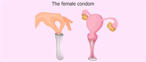 How To Use Girls Condom Online Deals Save 57 Jlcatjgobmx