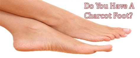 Charcot Foot Is A Serious Foot Disorder Chiropractor San Diego Dr